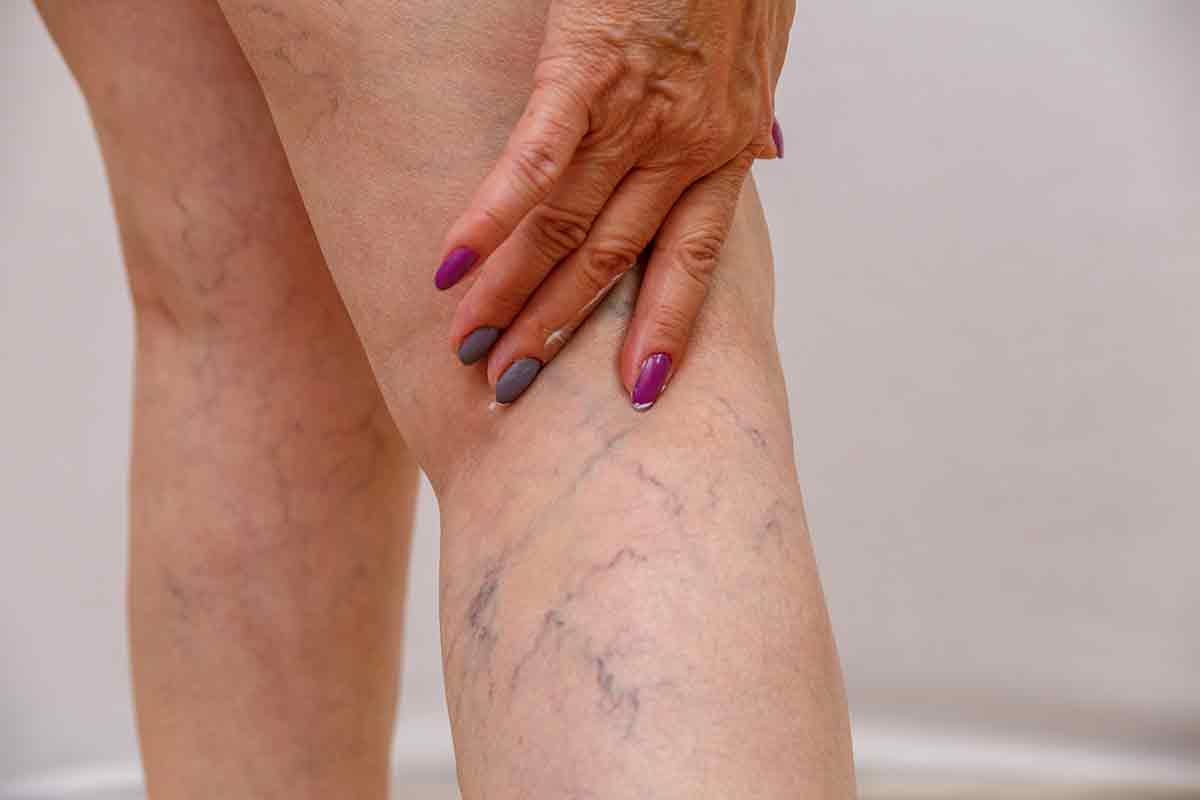 5Spider Vein Treament in Cedar ParkSpider Vein Treament in Cedar ParkSpider Vein Treament in Cedar ParkSpider Vein Treatment in Cedar Park0
